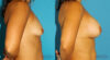 Breast Augmentation case #5614 slider thumbnail