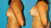 Breast Augmentation case #5614 slider thumbnail