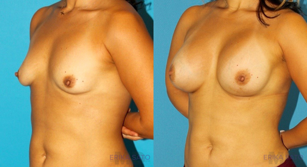 Breast Augmentation case #5614