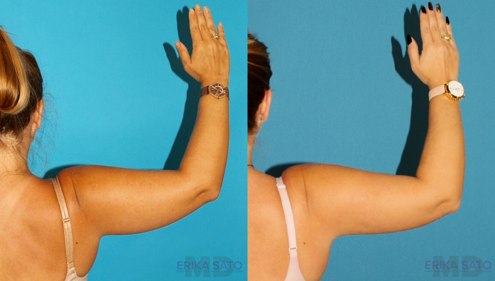 Liposuction case #5893