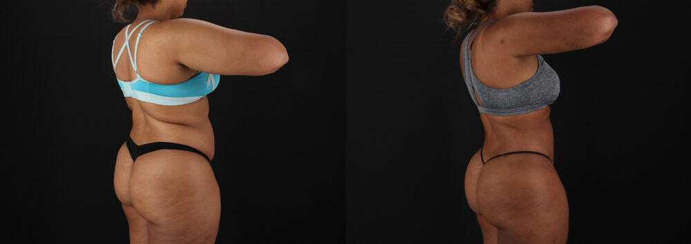 Brazilian Butt Lift case #5513