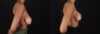 Breast Reduction case #8025 slider thumbnail