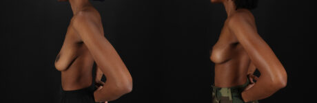 Breast Lift case #7806