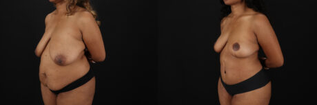 Post Bariatric Surgery (Massive Weight Loss) case #6782