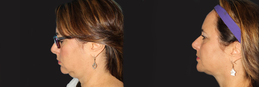 Submental Liposuction case #6945