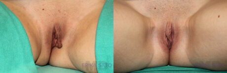 Labiaplasty case #5540