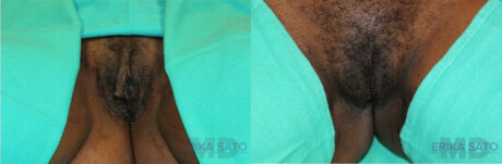 Labiaplasty case #5537