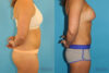 Liposuction case #5883 slider thumbnail