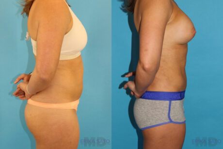 Liposuction case #5883