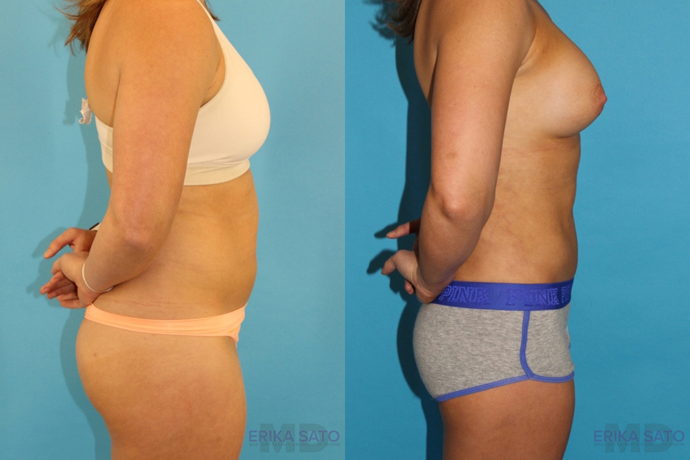 Liposuction case #5883