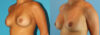 Revision Breast Surgery case #256254 slider thumbnail