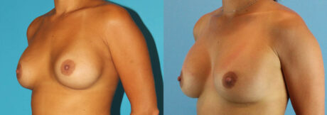 Revision Breast Surgery case #256254
