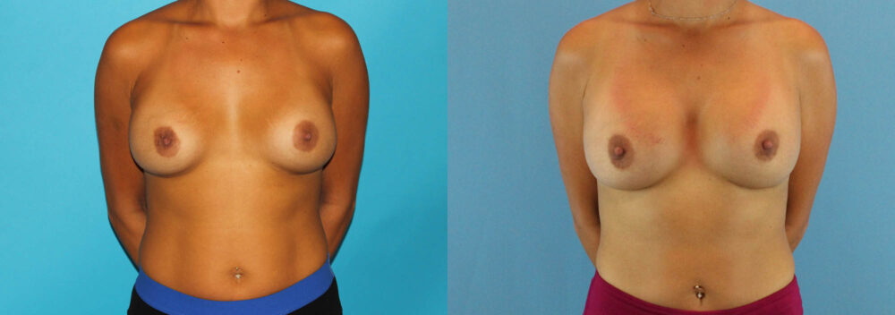 Revision Breast Surgery case #256254