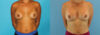 Revision Breast Surgery case #256254 slider thumbnail