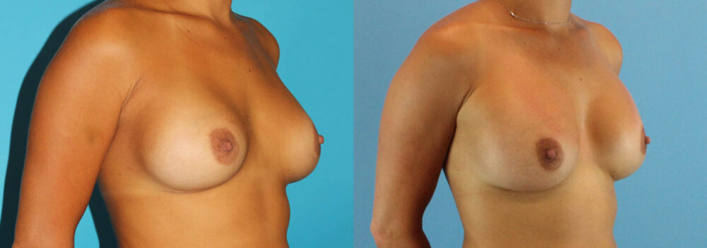 Revision Breast Surgery case #256254