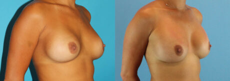 Revision Breast Surgery case #256254