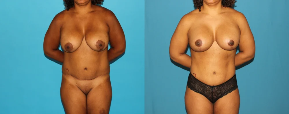 Mommy Makeover case #6507