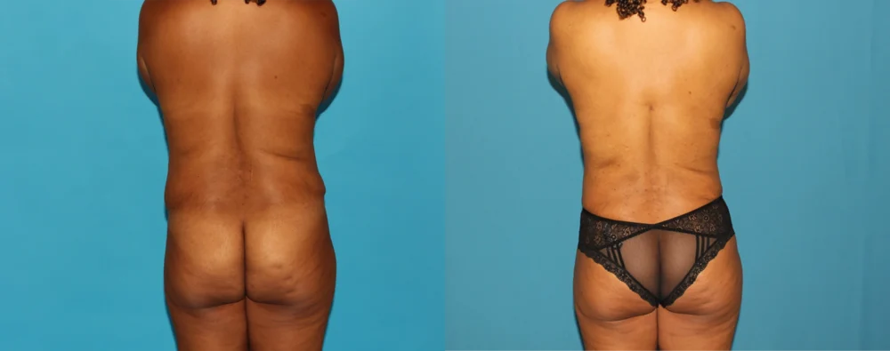 Mommy Makeover case #6507