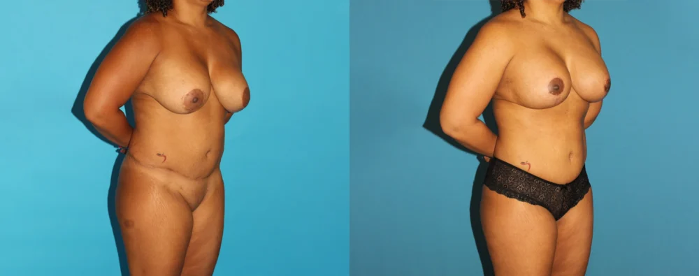 Mommy Makeover case #6507