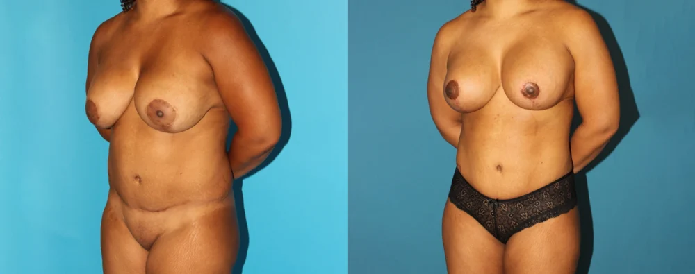 Mommy Makeover case #6507