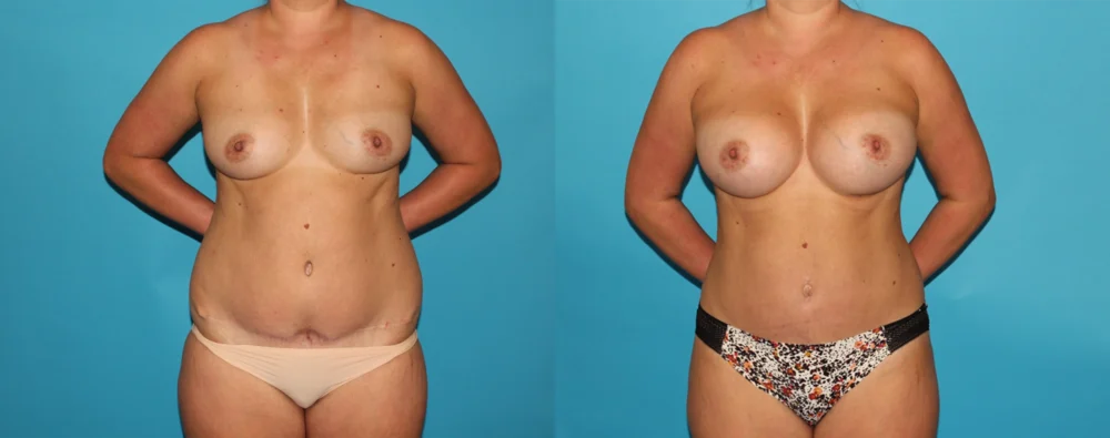 Mommy Makeover case #6508