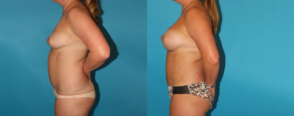 Mommy Makeover case #6508