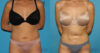 Liposuction case #5839 slider thumbnail