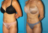Liposuction case #5839 slider thumbnail