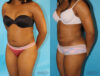 Liposuction case #5838 slider thumbnail