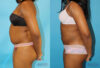 Liposuction case #5838 slider thumbnail