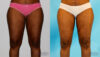 Liposuction case #5837 slider thumbnail