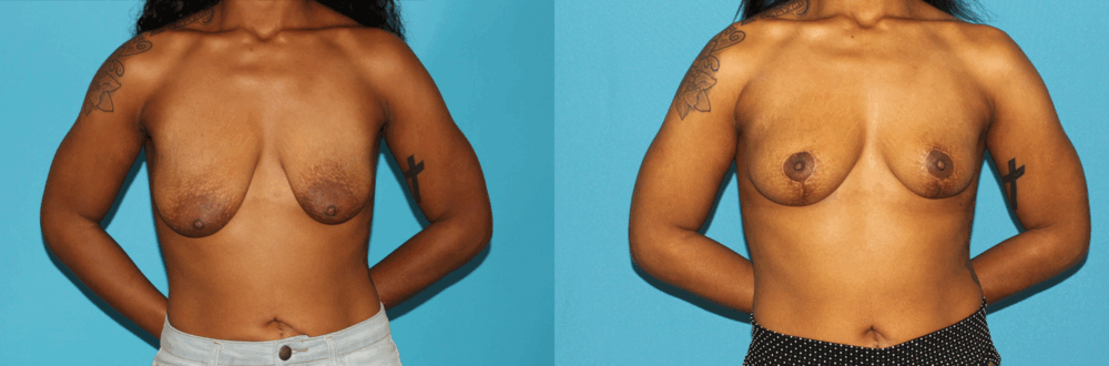Breast Lift case #7005