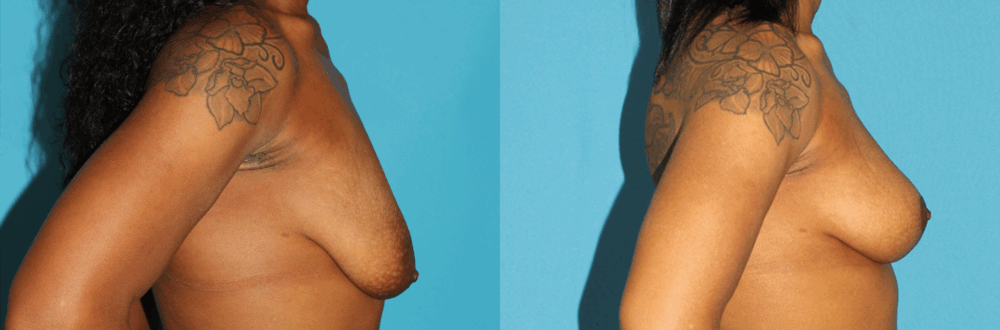 Breast Lift case #7005