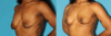 Breast Lift case #7005 slider thumbnail