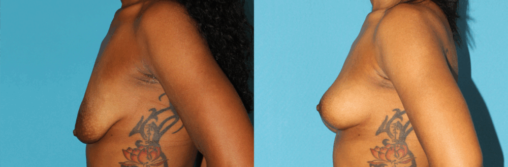 Breast Lift case #7005