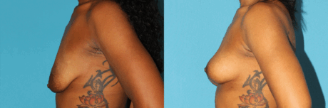 Breast Lift case #7005