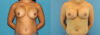 Revision Breast Surgery case #256248 slider thumbnail