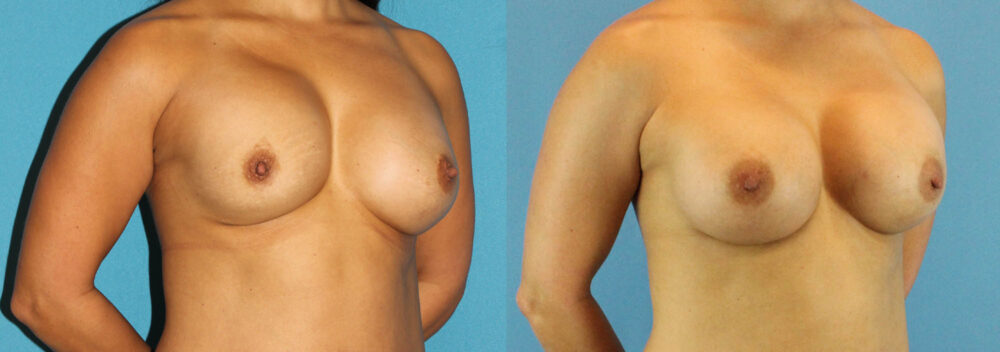 Revision Breast Surgery case #256248