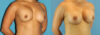 Revision Breast Surgery case #256248 slider thumbnail