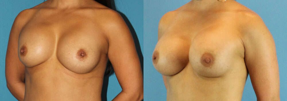 Revision Breast Surgery case #256248
