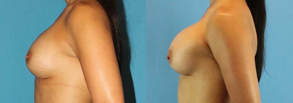 Revision Breast Surgery case #256248