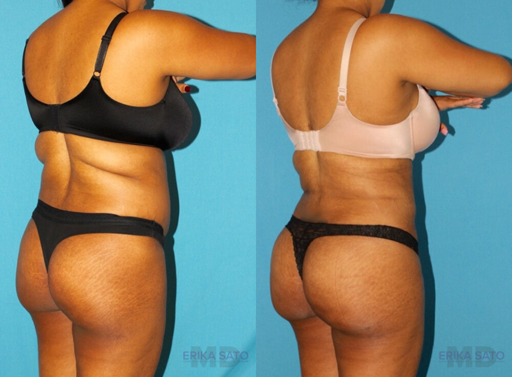 Brazilian Butt Lift case #4676