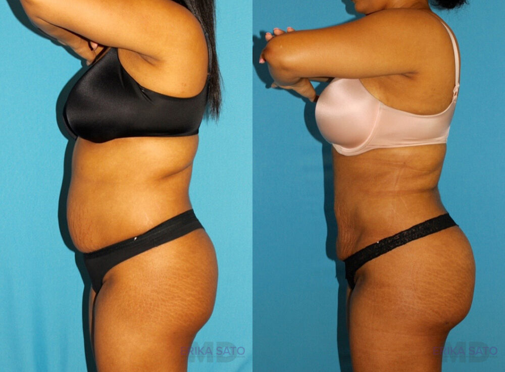 Brazilian Butt Lift case #4676