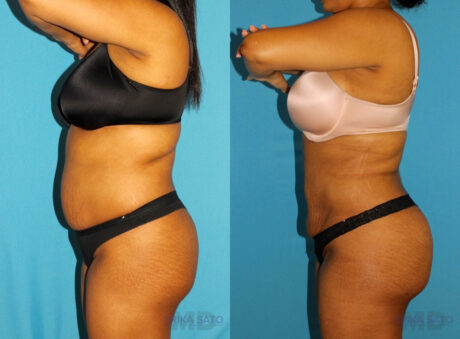 Brazilian Butt Lift case #4676