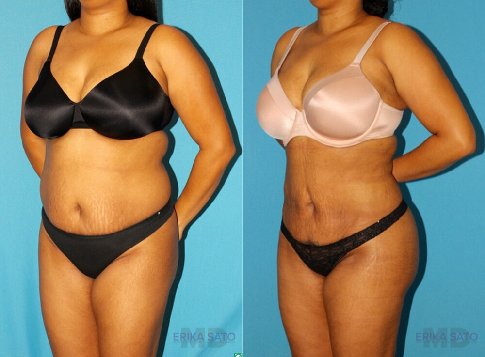 Brazilian Butt Lift case #4676