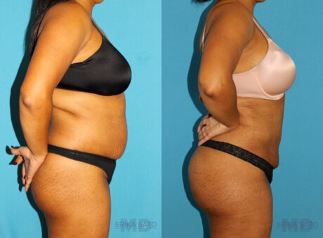 Brazilian Butt Lift case #4676