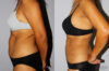 Liposuction case #5835 slider thumbnail