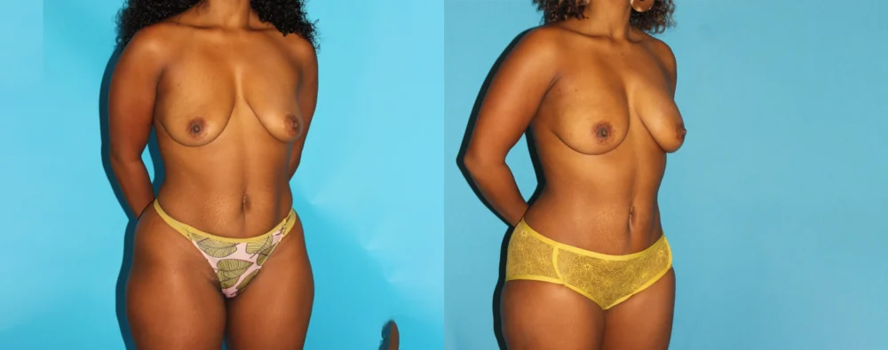 Mommy Makeover case #6509