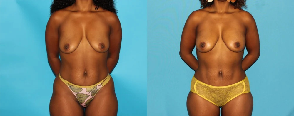 Mommy Makeover case #6509