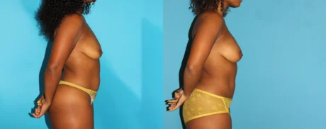 Mommy Makeover case #6509